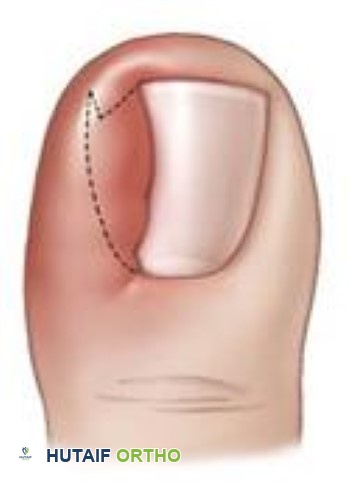 صورة توضيحية لظفر غارز في اللحم